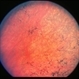 Retinitis Pigmentosa